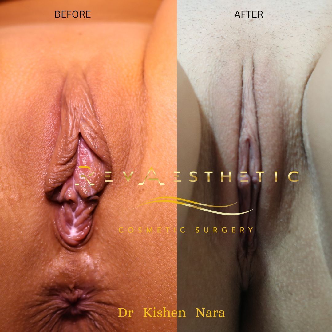 Labiaplasty before and after — Labia minoraplasty + clitoral hood reduction + anal tag removal, before and after, Case 3, Dr Kishen Nara